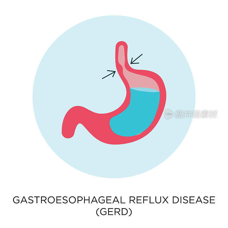 胃食管反流病(GERD)矢量图标，平面风格的插图，圆形设计，黑色类型，信息图，股票插图。