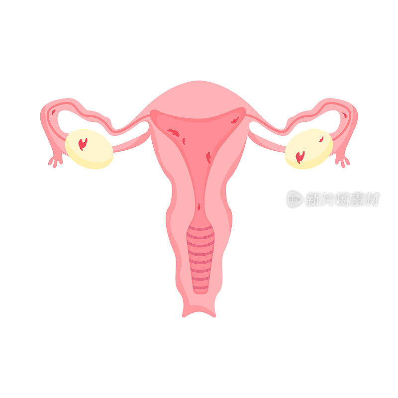 女性生殖器。子宫内膜异位、矢量插图