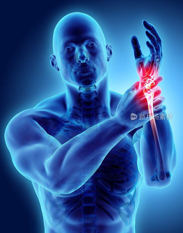手腕疼痛-骨骼x光片。