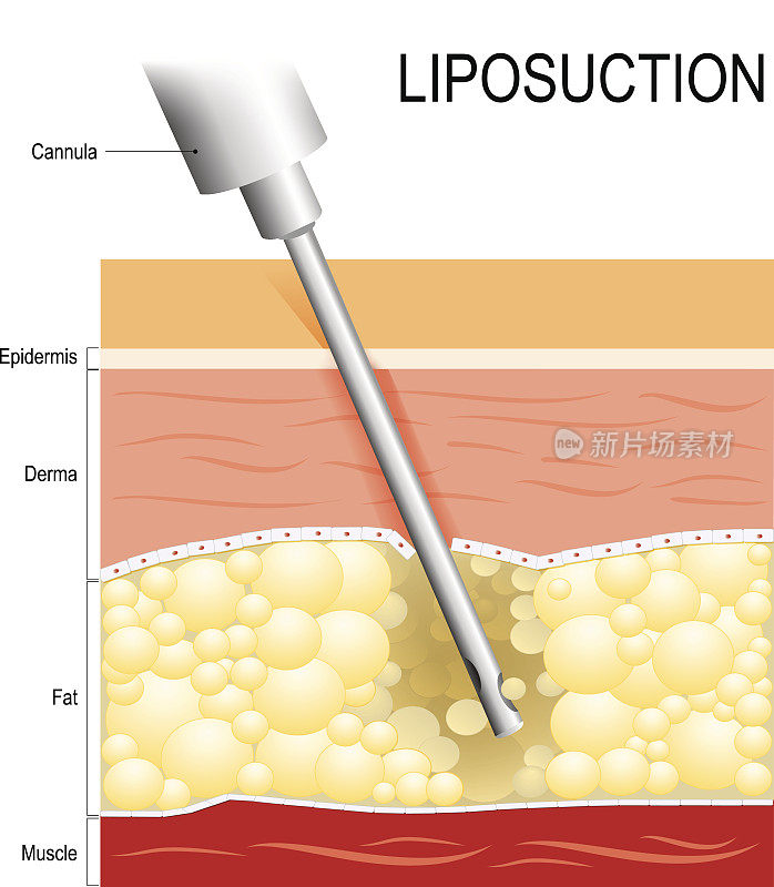 抽脂。插入皮下脂肪层。