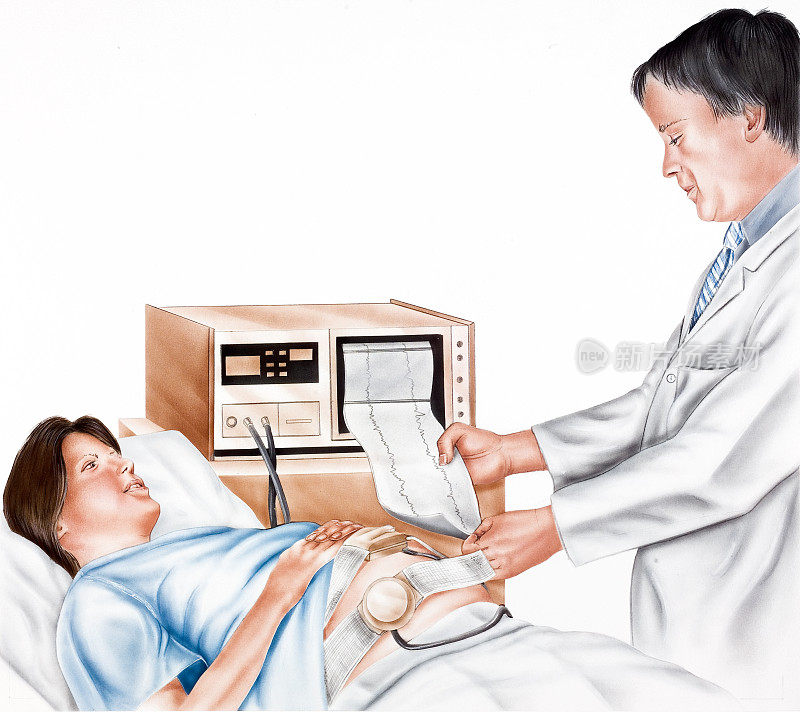 分娩-胎儿监测