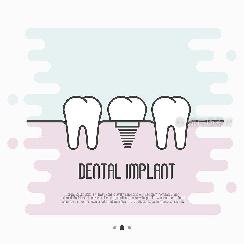 植牙概念:两颗健康的牙齿和植牙之间。细线矢量插图。