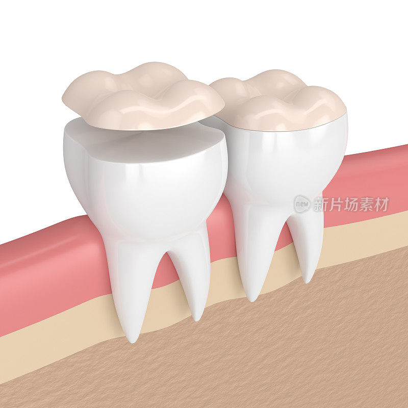 牙齿的3d渲染与牙齿高嵌