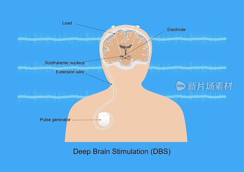 深部脑刺激治疗帕金森病