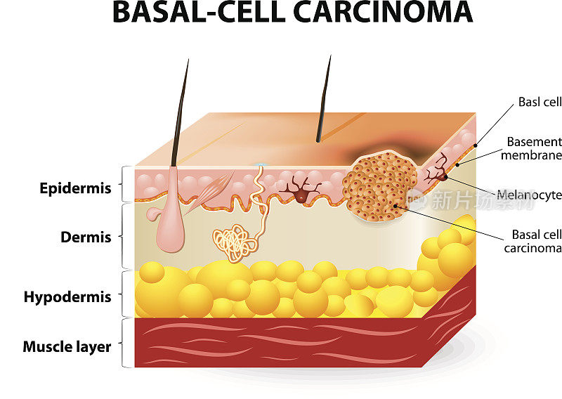基底细胞癌或基底细胞癌