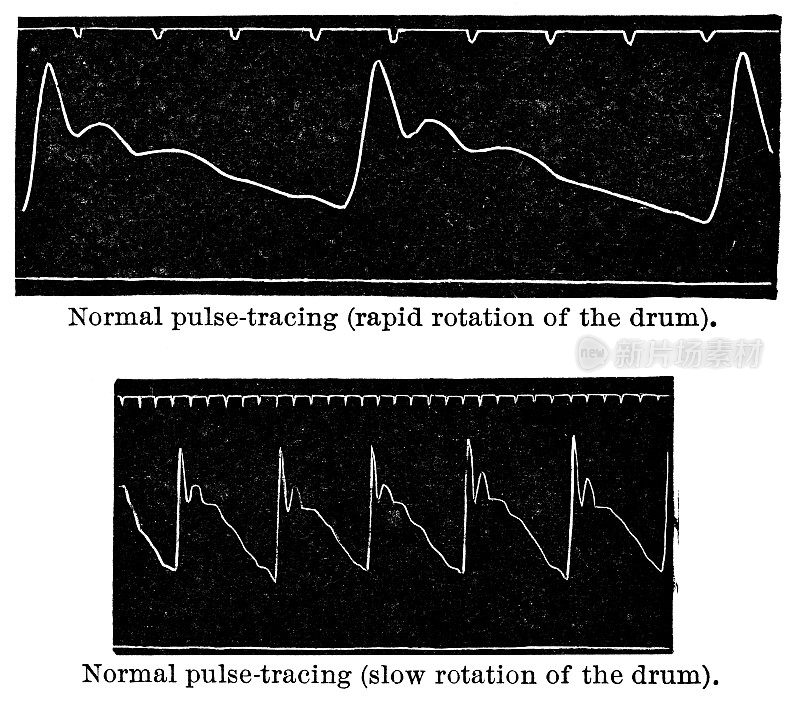 19世纪的脉搏描记器