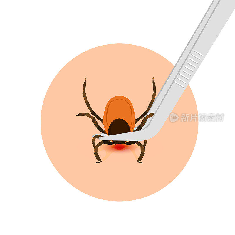 去除脑炎蜱叮咬后。如何去除螨虫。寄生虫携带疾病。