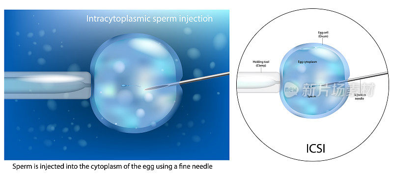 胞浆内精子注射ICSI的过程。人工授精体外受精。体外受精宏。科学的图