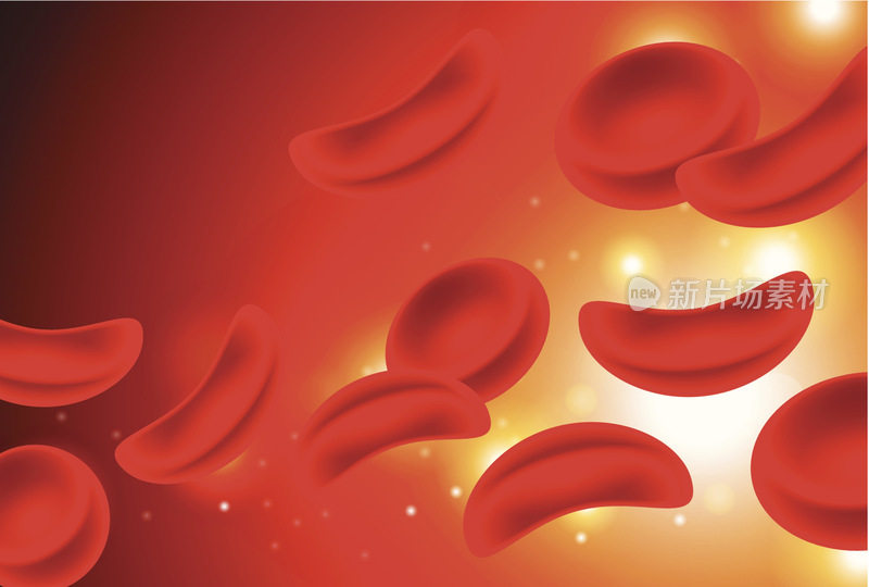 镰状细胞性贫血血液中的红细胞