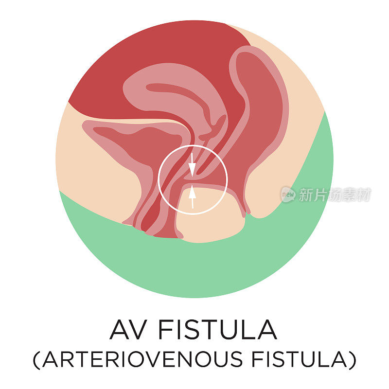 房室瘘管(动静脉瘘管)扁平型矢量插图，圆形布局，医学信息图