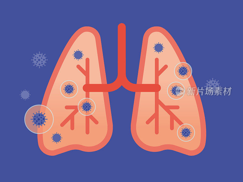 人体肺部横切面与病毒感染载体图解