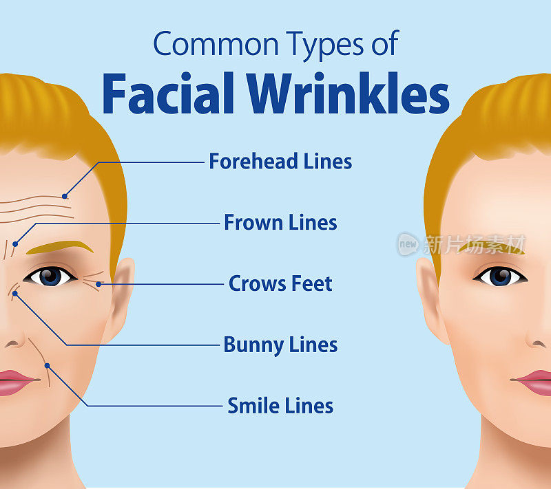 常见的面部皱纹类型。整容手术。女性面部护理理念。