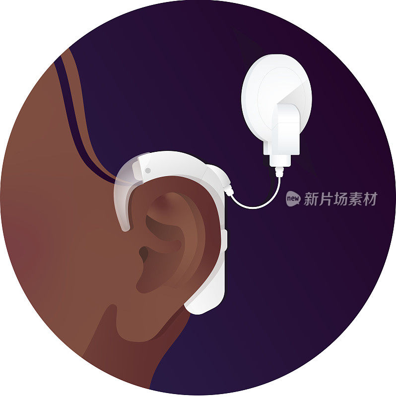 皮肤黝黑，植入白色耳蜗以帮助听力丧失的女性