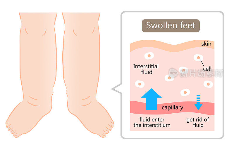 肿胀的脚的图解说明。肿胀是由身体组织内过多的液体引起的。卫生保健的概念
