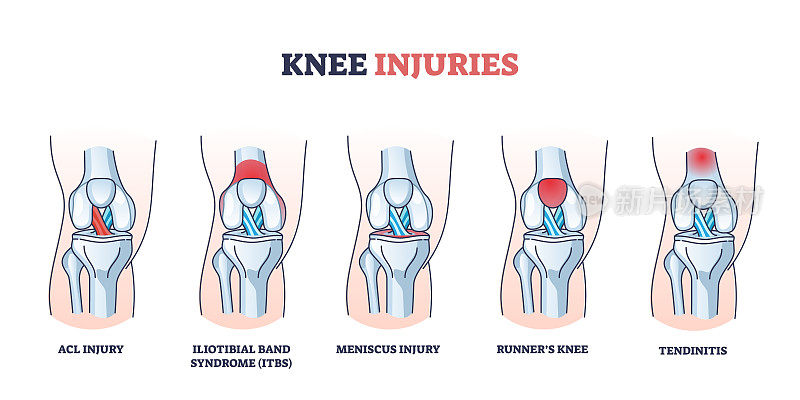 膝关节损伤伴医用骨、韧带和肌肉外伤轮廓图