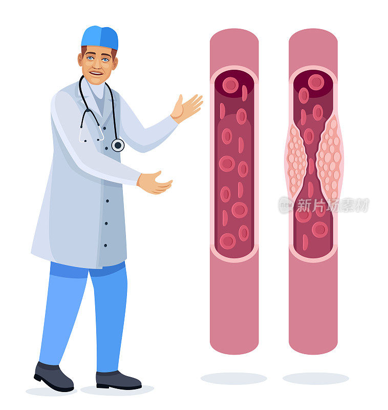 医生在检查血管中的胆固醇。血管。