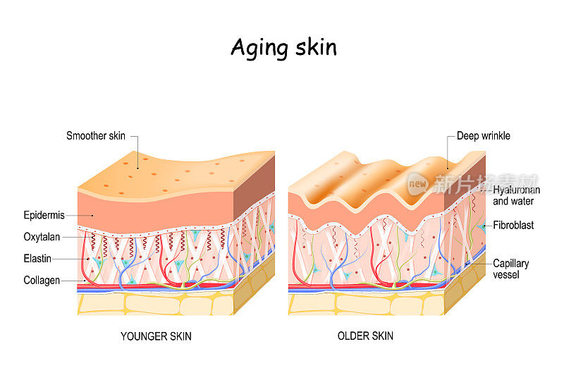老化的皮肤。老年皮肤和年轻皮肤的比较和区别。成纤维细胞，胶原蛋白，弹性蛋白，和Oxytalan纤维，透明质酸特写。