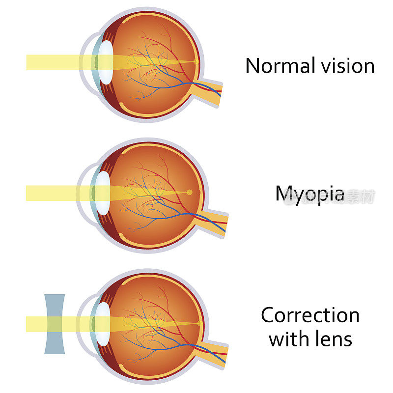 近视眼和近视眼用减透镜矫正。