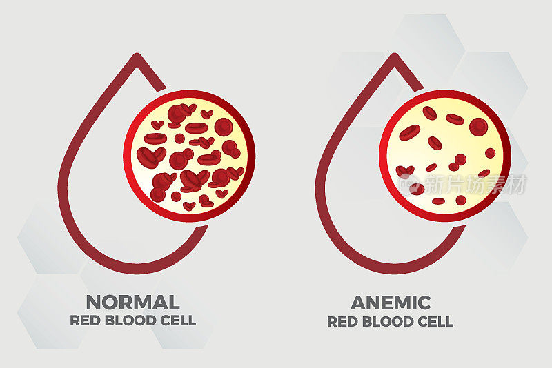 贫血铁红细胞医学载体插图医学。