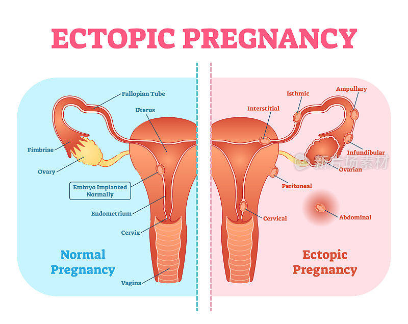 异位妊娠或输卵管妊娠有女性生殖系统和各种胚胎附着位置的医学图。