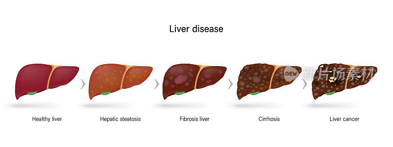肝脏疾病。肝损伤的分期。健康肝、肝脂肪变性、肝纤维化、肝硬化、肝癌。