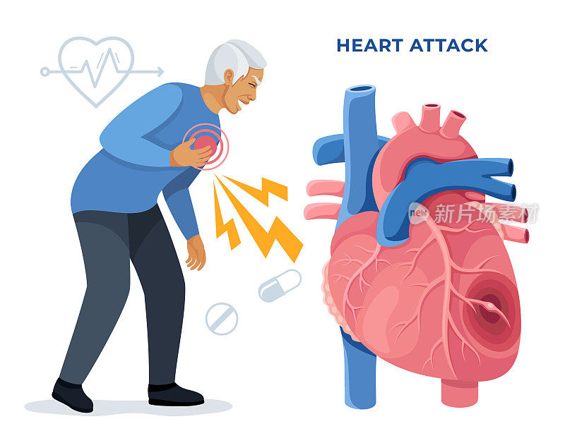 一名男子心脏病发作。识别心脏病发作的迹象。