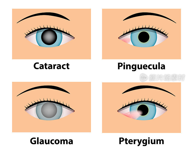 白内障，翼状胬肉，青光眼和青光眼，眼部护理