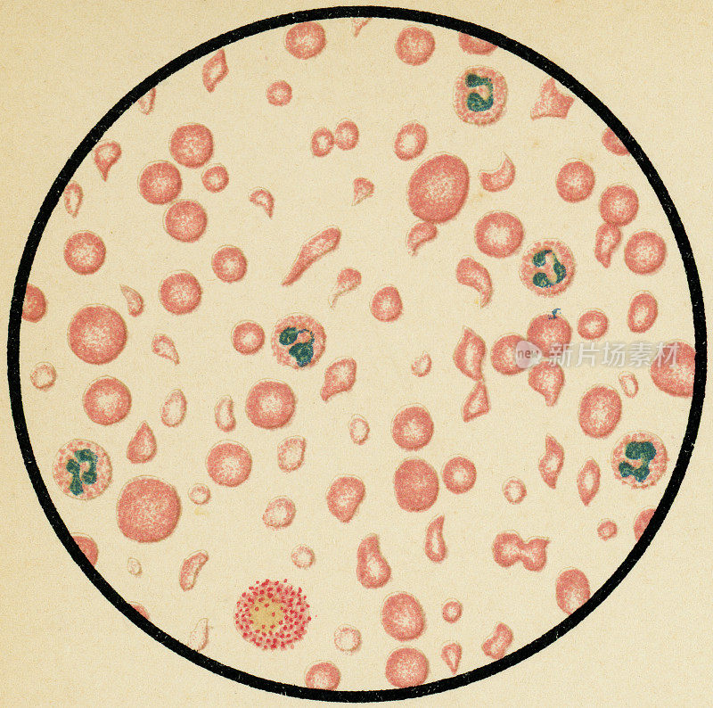 19世纪一例严重贫血患者的红细胞异kilocysis的显微镜观察