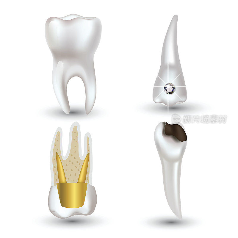 矢量集的3d现实清洁和肮脏的牙齿孤立在白色的背景。牙齿健康的概念。口腔护理，牙齿修复
