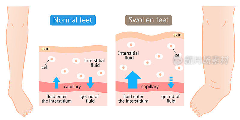 足部肿胀，正常，有皮肤图。肿胀是由身体组织内过多的液体引起的。之前在插图。卫生保健的概念