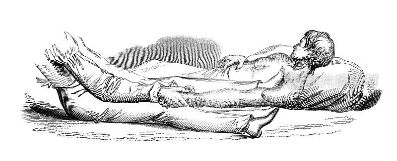 19世纪的医疗程序雕刻