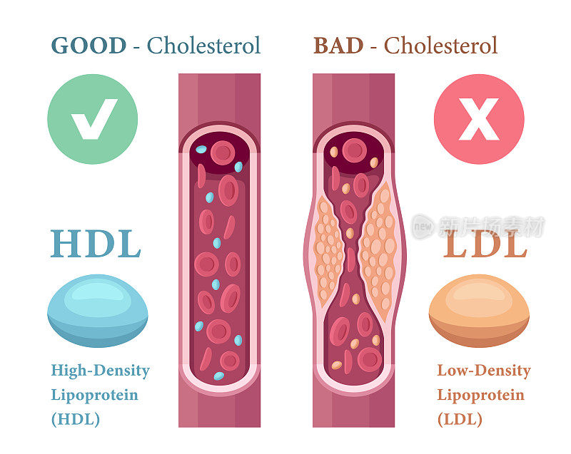 血液中胆固醇的种类。高密度脂蛋白(HDL)和低密度脂蛋白(LDL)。