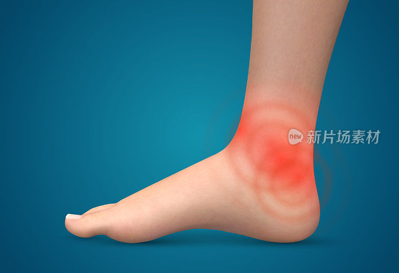 向量人脚。疼痛的红斑。用于医学和骨科的现成元素