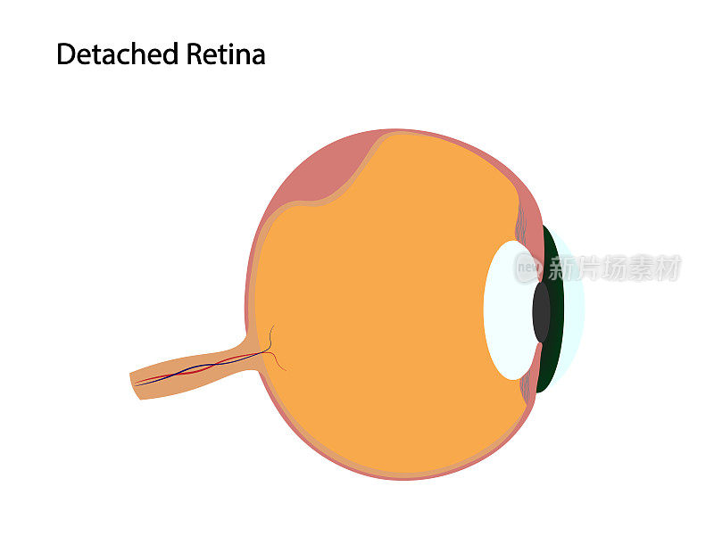 视网膜脱离插图。视网膜脱落的眼睛