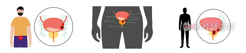 膀胱癌阶段