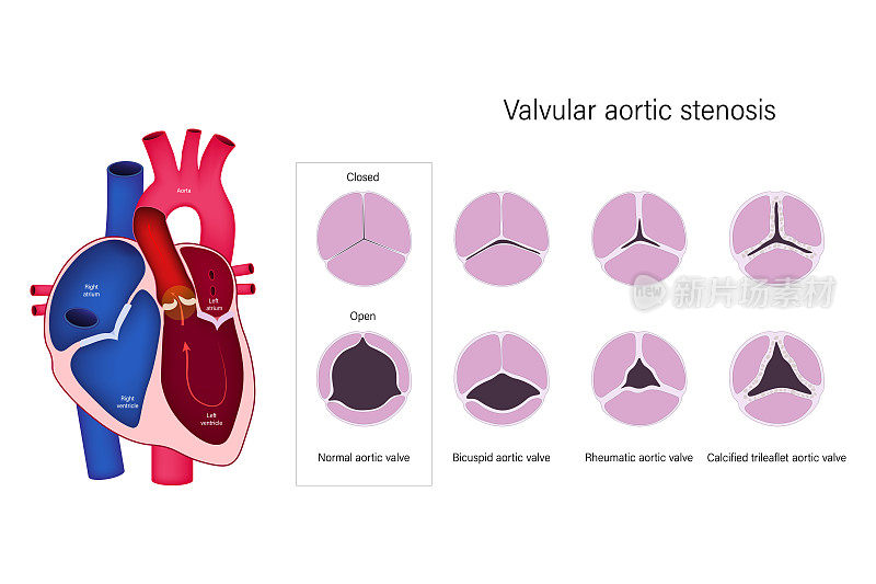 主动脉瓣狭窄。正常主动脉瓣、二尖瓣、风湿性主动脉瓣、钙化三瓣主动脉瓣。