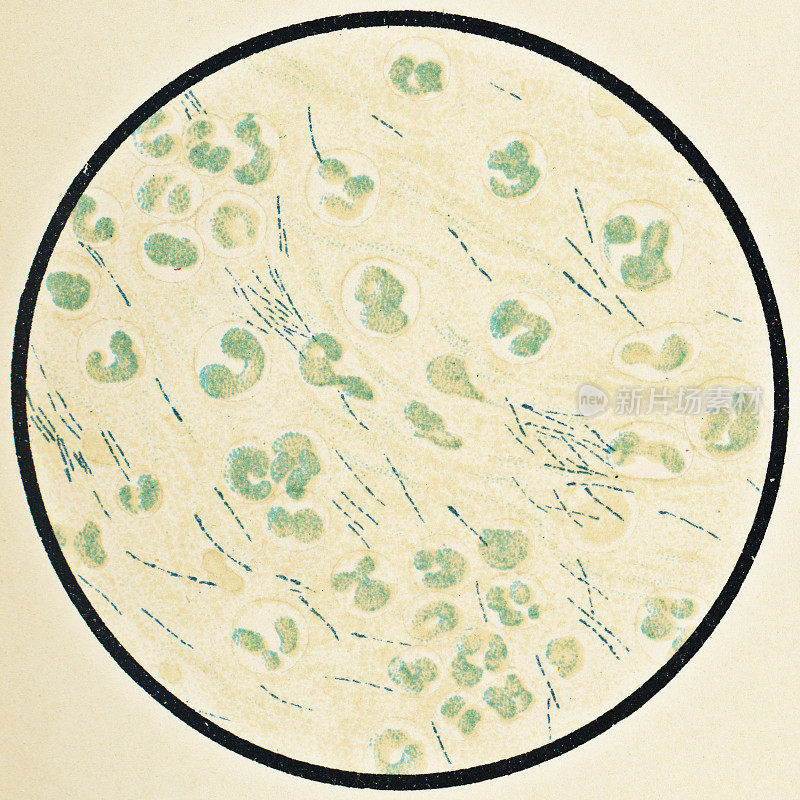 19世纪患者的人体血细胞和马利伯克霍尔德氏菌的显微镜观察