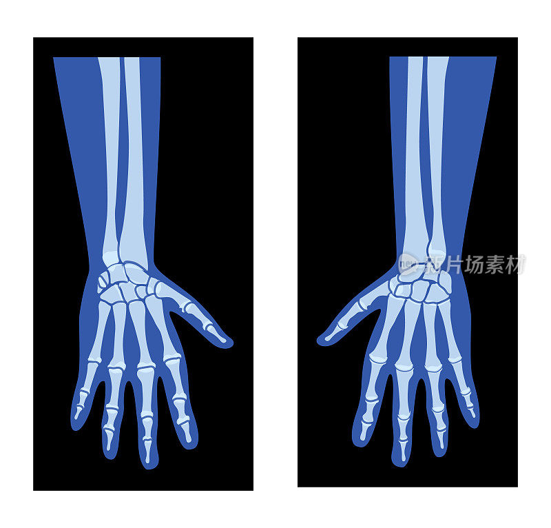 手部x光带桡骨，尺骨骨骼人体，骨成人伦琴前观。三维逼真的平面蓝色概念矢量插图医学解剖学隔离在黑色背景