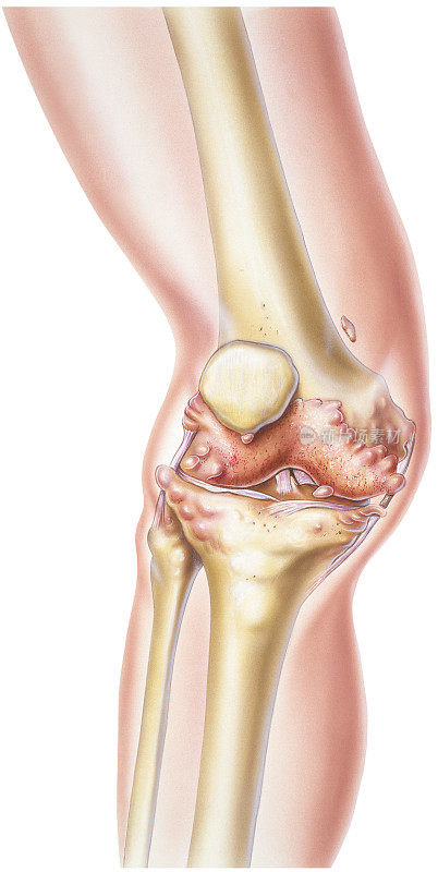 膝关节-类风湿关节炎