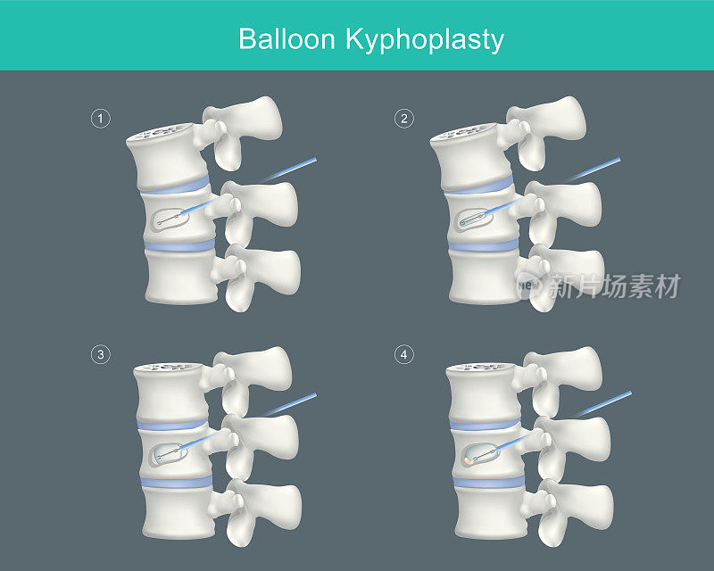 气球Kyphoplasty。矫正压缩性骨折和恢复椎体高度的医疗步骤。插图。“n