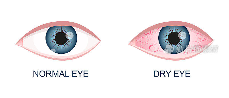 人的眼睛健康干燥。正常，眼球充血，发炎，结膜发红。角膜炎过敏结膜炎葡萄膜炎向量的卡通插图