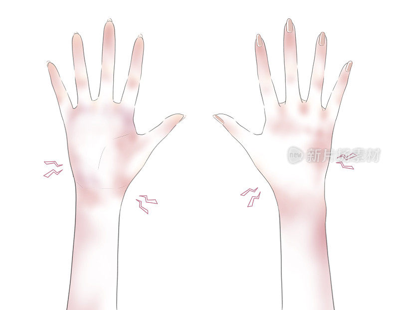 手部皲裂发炎发红的图示(4)