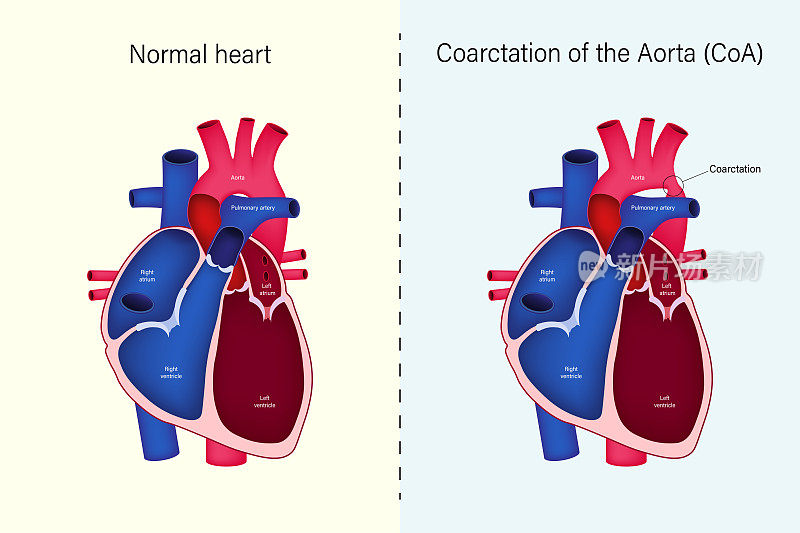 心脏正常与主动脉矢量缩窄的差异。先天性心脏病。