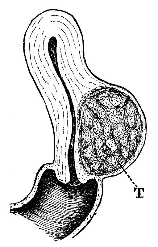 19世纪人类子宫壁内肌瘤的医学插图