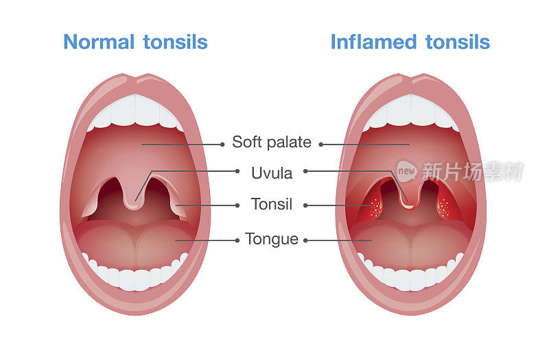 扁桃体正常和发炎。