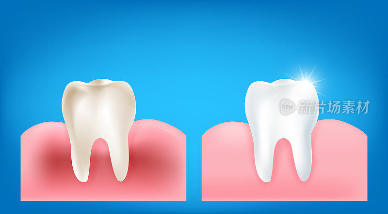 肮脏的牙齿和牙龈的收藏与干净和强壮的白色牙齿相比，闪烁明亮的光元素在蓝色背景