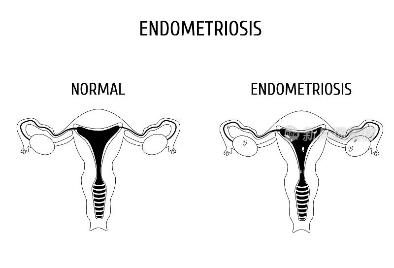 有或无子宫内膜异位症的女性生殖器官轮廓。信息图。