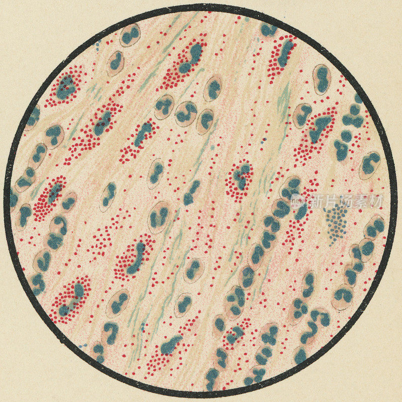 亚甲蓝和伊红19世纪染色的哮喘患者痰液中嗜酸性粒细胞和微球菌的显微镜观察