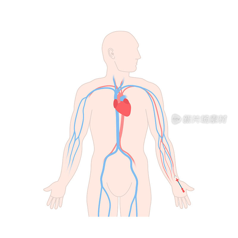 动脉导管置入人桡动脉