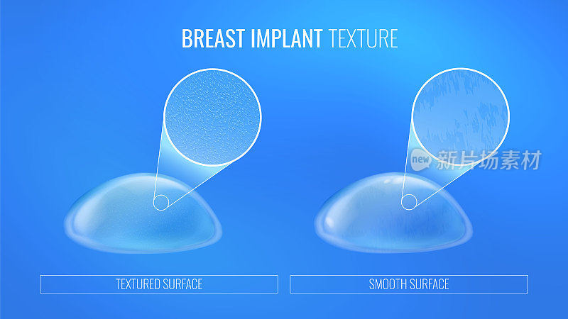现实风格的整形手术信息图中的乳房植入物表面类型。不同外部纹理的乳房假体对比图。带有光效的矢量